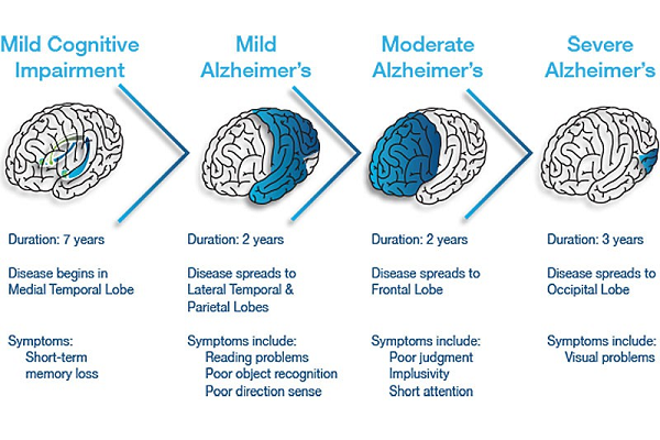 What are the Three Stages of Alzheimer’s Disease