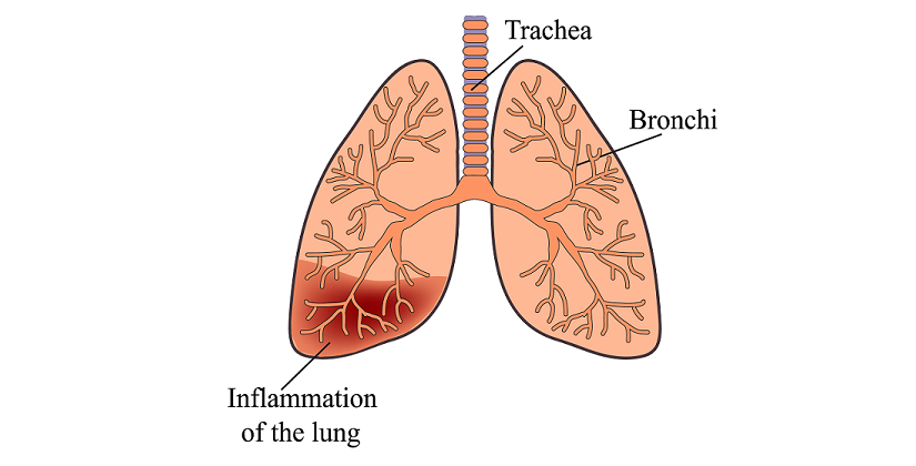 What Is a Pneumonia and How Does It Affect Seniors