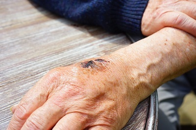 The Dangers of Pressure Sores Among Nursing Home Residents