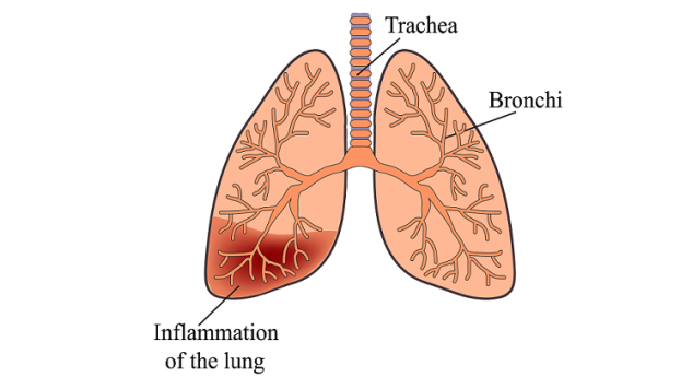 What Is a Pneumonia and How Does It Affect Seniors