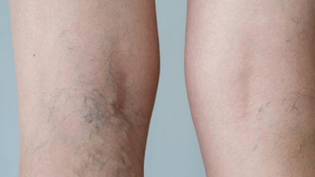 Are Your Spider Veins Trying To Tell You Something?
